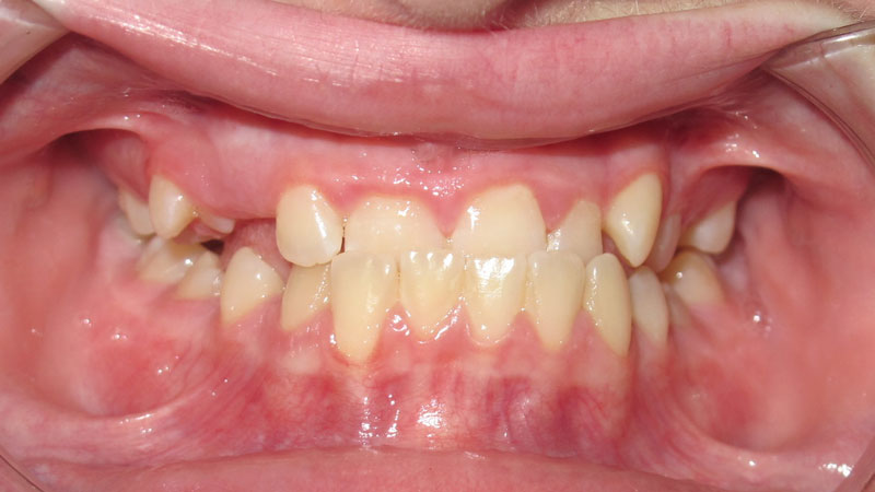 Kiara-Feilburg-Before Kiara-Feilburg-Before