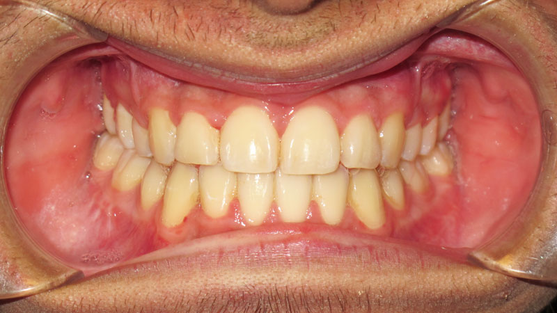 Tony-Alvarado-After Tony-Alvarado-After