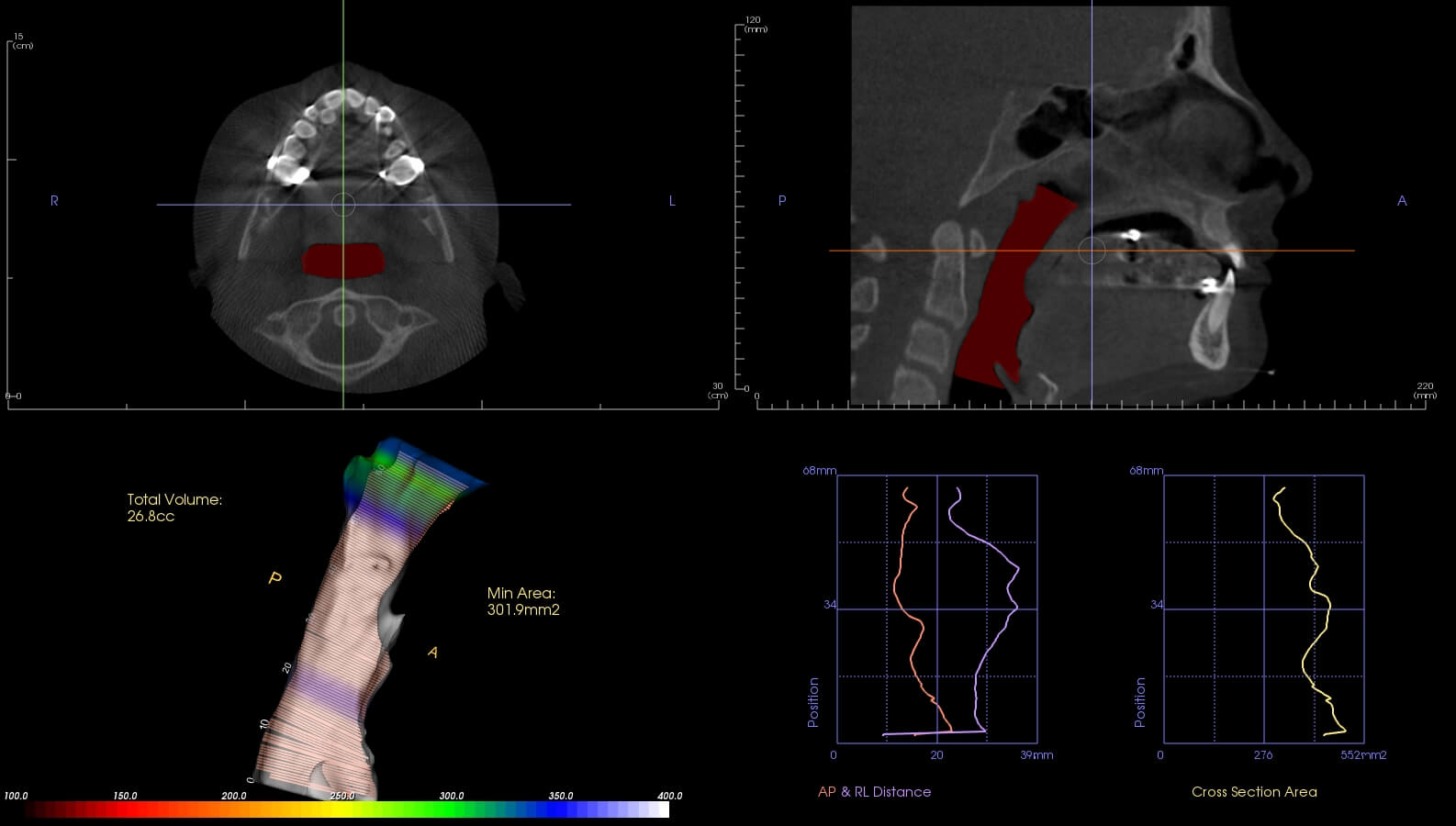 Marlo Miller – Before & After Airway Photos Marlo Miller - Before & After Airway Photos
