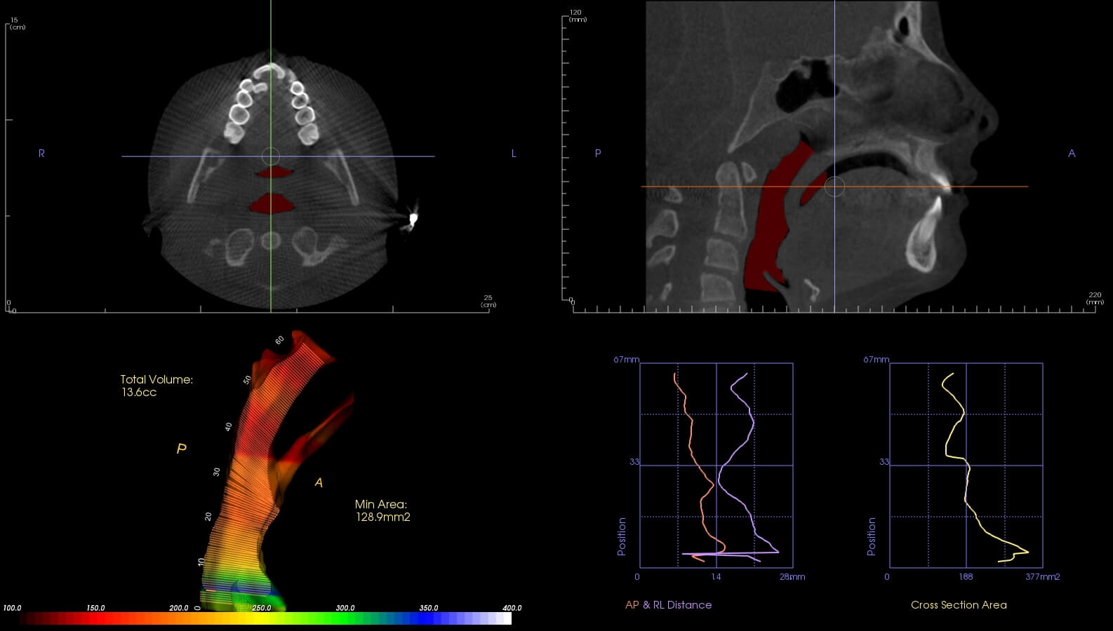 Marlo Miller – Before & After Airway Photos Marlo Miller - Before & After Airway Photos