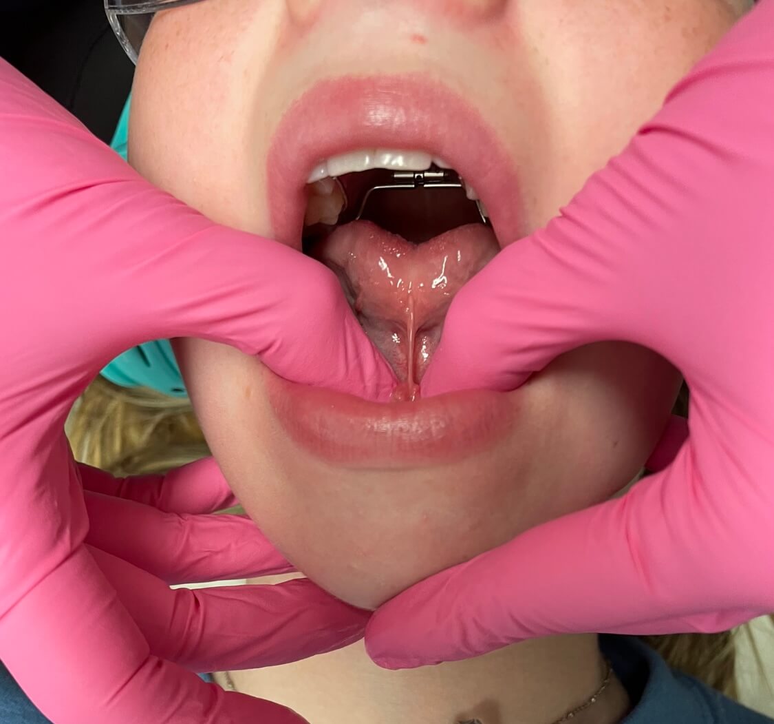 Marlo Miller – Before & After Tongue Tie Marlo Miller - Before & After Tongue Tie