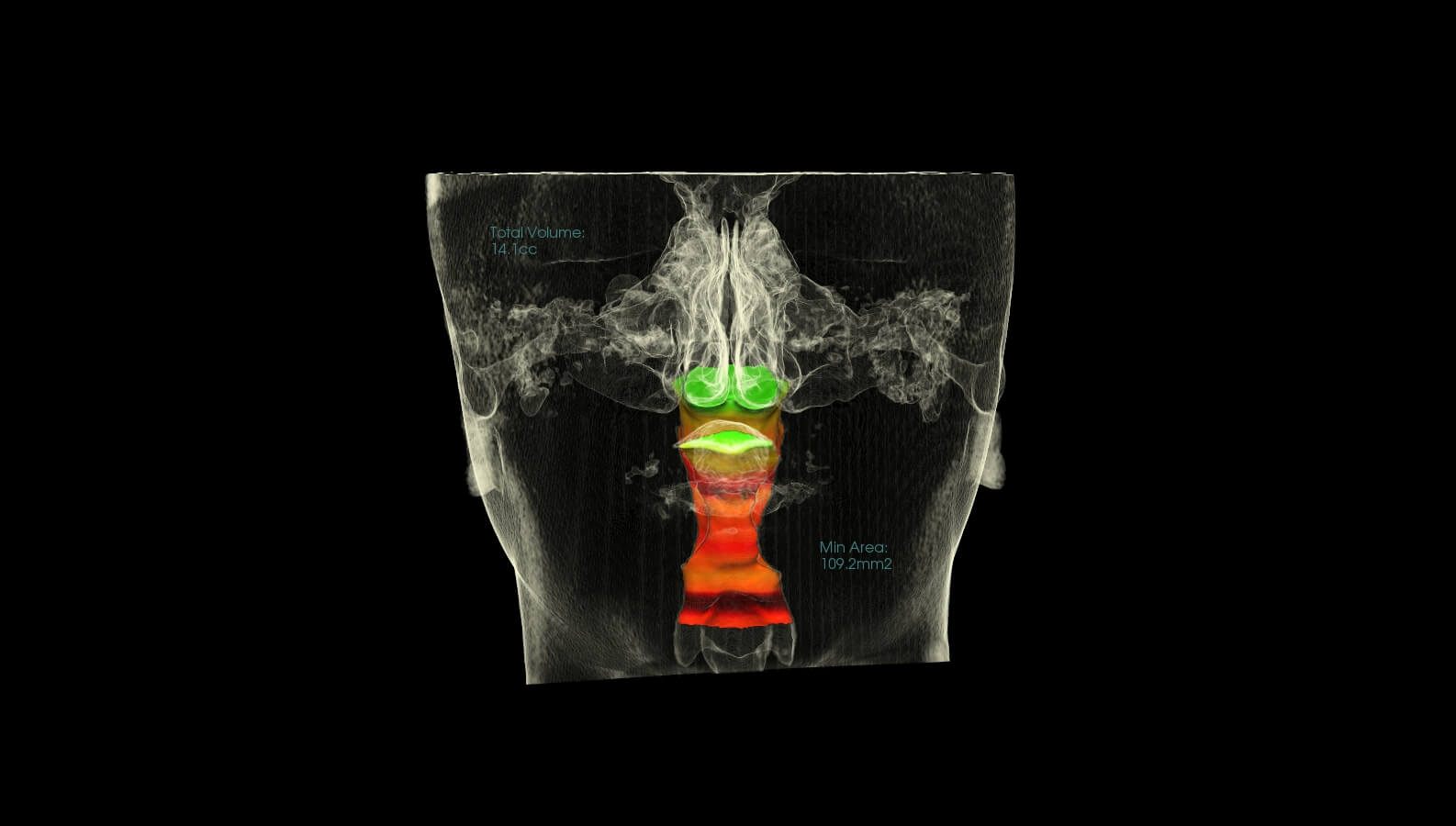 Marlo Miller – Before & After Airway Photos Marlo Miller - Before & After Airway Photos